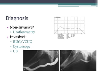 Diagnosis
• Non-Invasive2
▫ Uroflowmetry
• Invasive3
▫ RUG/VCUG
▫ Cystoscopy
▫ US
 