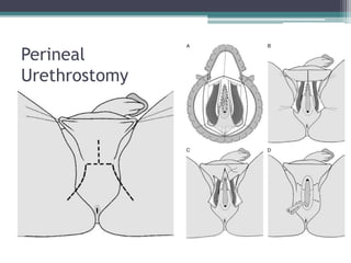 Perineal
Urethrostomy
 