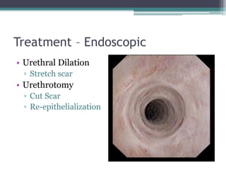 Treatment – Endoscopic
• Urethral Dilation
▫ Stretch scar
• Urethrotomy
▫ Cut Scar
▫ Re-epithelialization
 