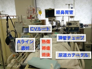 挿管チューブ
経鼻胃管
CVルート
Aライン
透析
尿道カテーテル
熱傷
褥瘡
術後
 