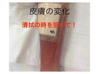 皮膚の変化
清拭の時を狙って！
 