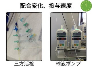 配合変化、投与速度
三方活栓 輸液ポンプ
 