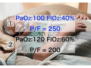 PaO2:100 FIO2:40%
P/F = 250
PaO2:120 FIO2:60%
P/F = 200
①
②
 