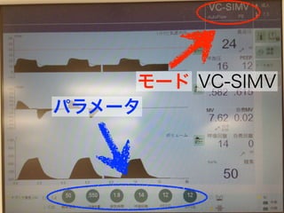 モード
パラメータ
VC-SIMV
 
