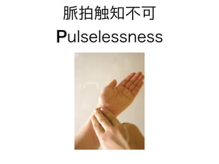 脈拍触知不可
Pulselessness
 