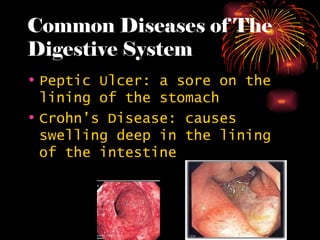 Common Diseases of The Digestive System Peptic Ulcer: a sore on the lining of the stomach Crohn’s Disease: causes swelling deep in the lining of the intestine 
