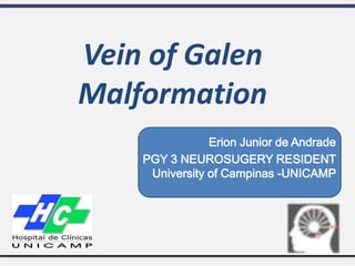 Erion Junior de Andrade
PGY 3 NEUROSUGERY RESIDENT
University of Campinas -UNICAMP
Vein of Galen
Malformation
 