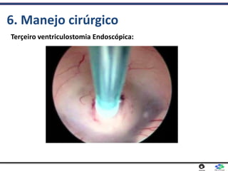 6. Manejo cirúrgico
Terçeiro ventriculostomia Endoscópica:
 