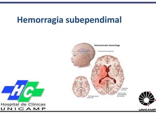 Erion Junior de Andrade
R1 NEUROCIRURGIA - UNICAMP
Hemorragia subependimal
 