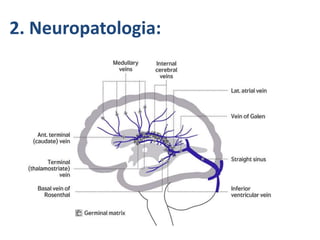 GMH/IVH :-
2. Neuropatologia:
 