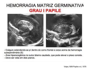 5. Diagnóstico:
Volpe,1989 Papile e cl, 1978
 