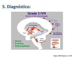 5. Diagnóstico:
Volpe,1989 Papile e cl, 1978
 