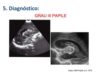 5. Diagnóstico:
Volpe,1989 Papile e cl, 1978
 
