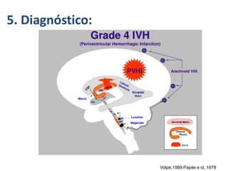 5. Diagnóstico:
Volpe,1989 Papile e cl, 1978
 