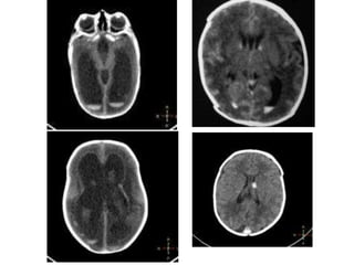 Hemorragia intraventricular e Hemorragia Subependimal