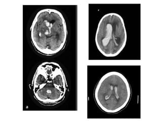 Hemorragia intraventricular e Hemorragia Subependimal
