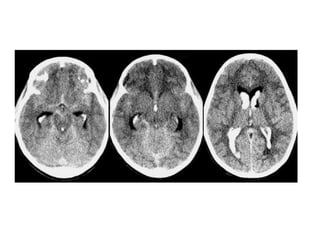 Hemorragia intraventricular e Hemorragia Subependimal