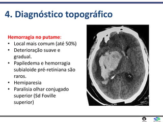 4. Diagnóstico topográfico
Hemorragia no putame:
• Local mais comum (até 50%)
• Deterioração suave e
gradual.
• Papiledema e hemorragia
subialoide pré-retiniana são
raros.
• Hemiparesia
• Paralisia olhar conjugado
superior (Sd Foville
superior)
 