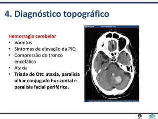 4. Diagnóstico topográfico
Hemorragia cerebelar
• Vômitos
• Sintomas de elevação da PIC;
• Compressão do tronco
encefálico
• Ataxia
• Tríade de Ott: ataxia, paralisia
olhar conjugado horizontal e
paralisia facial periférica.
 