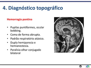 4. Diagnóstico topográfico
Hemorragia pontina
• Pupilas puntiformes, ocular
bobbing.
• Coma de forma abrupta.
• Padrão respiratório atáxico.
• Dupla hemiparesia e
hemianestesia.
• Paralisia olhar conjugado
bilateral
 