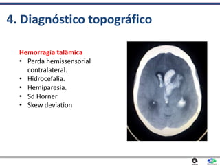 4. Diagnóstico topográfico
Hemorragia talâmica
• Perda hemissensorial
contralateral.
• Hidrocefalia.
• Hemiparesia.
• Sd Horner
• Skew deviation
 
