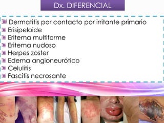 Dx. DIFERENCIAL
Dermatitis por contacto por irritante primario
Erisipeloide
Eritema multiforme
Eritema nudoso
Herpes zoster
Edema angioneurótico
Celulitis
Fascitis necrosante

 