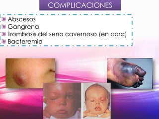 COMPLICACIONES
Abscesos
Gangrena
Trombosis del seno cavernoso (en cara)
Bacteremia

 