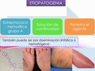 ETIOPATOGENIA

Estreptococo
ᵦhemolítico
grupo A

Solución de
continuidad

Penetra el
agente

También puede ser por diseminación linfática o
hematógena

 
