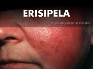 Infecciones piógenas dela piel
ERISIPELA
 