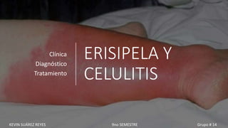 ERISIPELA Y
CELULITIS
Clínica
Diagnóstico
Tratamiento
KEVIN SUÁREZ REYES 9no SEMESTRE Grupo # 14
 