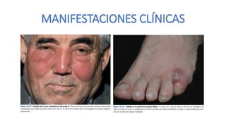 MANIFESTACIONES CLÍNICAS
 