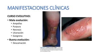 CURSO EVOLUTIVO:
• Mala evolución:
• Ampollas
• Purpura
• Necrosis
• Ulceración
• Gangrena
• Buena evolución:
• Descamación
MANIFESTACIONES CLÍNICAS
 