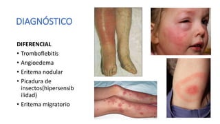 DIAGNÓSTICO
DIFERENCIAL
• Tromboflebitis
• Angioedema
• Eritema nodular
• Picadura de
insectos(hipersensib
ilidad)
• Eritema migratorio
 