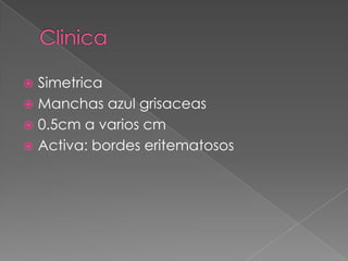 Simetrica
 Manchas azul grisaceas
 0.5cm a varios cm
 Activa: bordes eritematosos


 