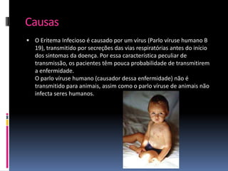 Causas
 O Eritema Infecioso é causado por um vírus (Parlo víruse humano B
   19), transmitido por secreções das vias respiratórias antes do início
   dos sintomas da doença. Por essa característica peculiar de
   transmissão, os pacientes têm pouca probabilidade de transmitirem
   a enfermidade.
   O parlo víruse humano (causador dessa enfermidade) não é
   transmitido para animais, assim como o parlo víruse de animais não
   infecta seres humanos.
 