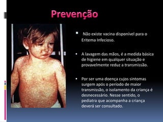     Não existe vacina disponível para o
    Eritema Infecioso.


 A lavagem das mãos, é a medida básica
    de higiene em qualquer situação e
    provavelmente reduz a transmissão.


 Por ser uma doença cujos sintomas
    surgem após o período de maior
    transmissão, o isolamento da criança é
    desnecessário. Nesse sentido, o
    pediatra que acompanha a criança
    deverá ser consultado.
 