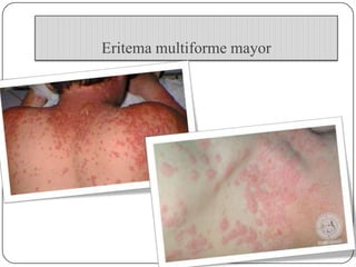 Eritema multiforme | PPTX