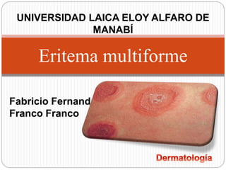 Eritema multiforme
Fabricio Fernando
Franco Franco
UNIVERSIDAD LAICA ELOY ALFARO DE
MANABÍ
 