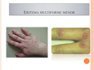 ERITEMA MULTIFORME MENOR
 