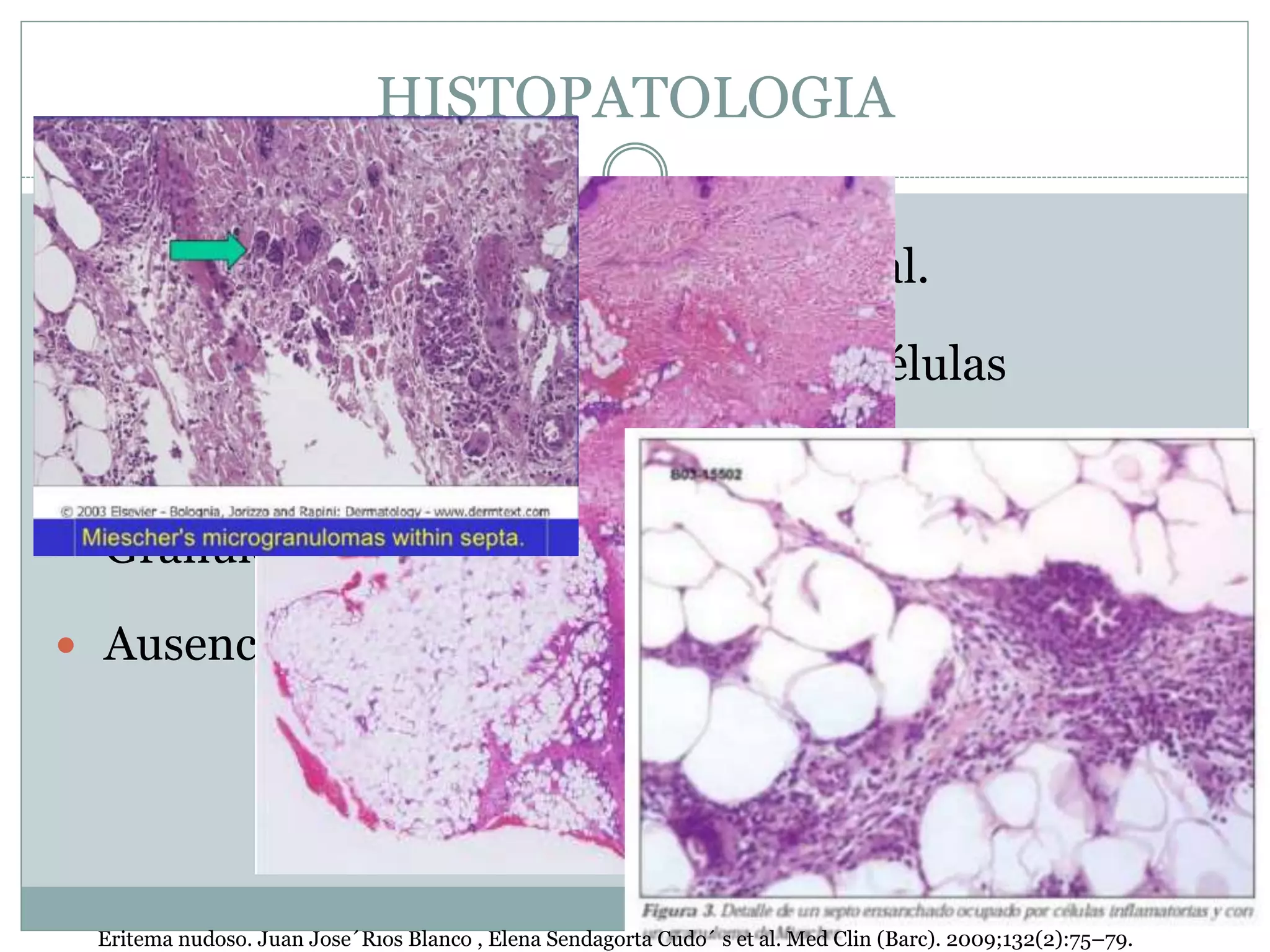 HISTOPATOLOGIA
 Lesión característica, paniculitis septal.
 Septos engrosados con infiltrado de células
inflamatorias.
 Granuloma radial de Miescher
 Ausencia de vasculitis.
Eritema nudoso. Juan Jose´Rıos Blanco , Elena Sendagorta Cudo´ s et al. Med Clin (Barc). 2009;132(2):75–79.
 