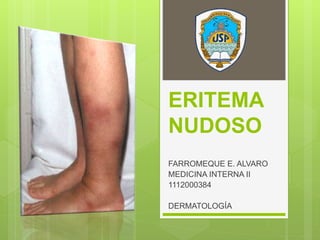 ERITEMA
NUDOSO
FARROMEQUE E. ALVARO
MEDICINA INTERNA II
1112000384
DERMATOLOGÍA
 