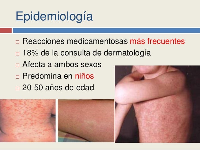 Enfrente a nata de lugares de pigmentary e enguias