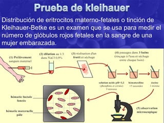 Distribución de eritrocitos materno-fetales o tinción de
Kleihauer-Betke es un examen que se usa para medir el
número de glóbulos rojos fetales en la sangre de una
mujer embarazada.
 