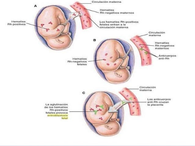 Resultado de imagen para eritroblastosis fetal