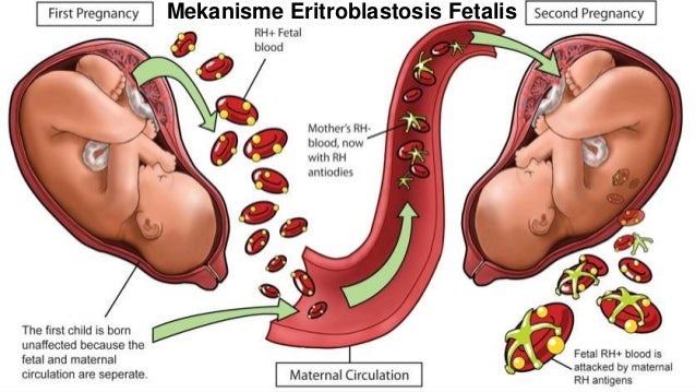 Image result for eritroblastosis fetalis