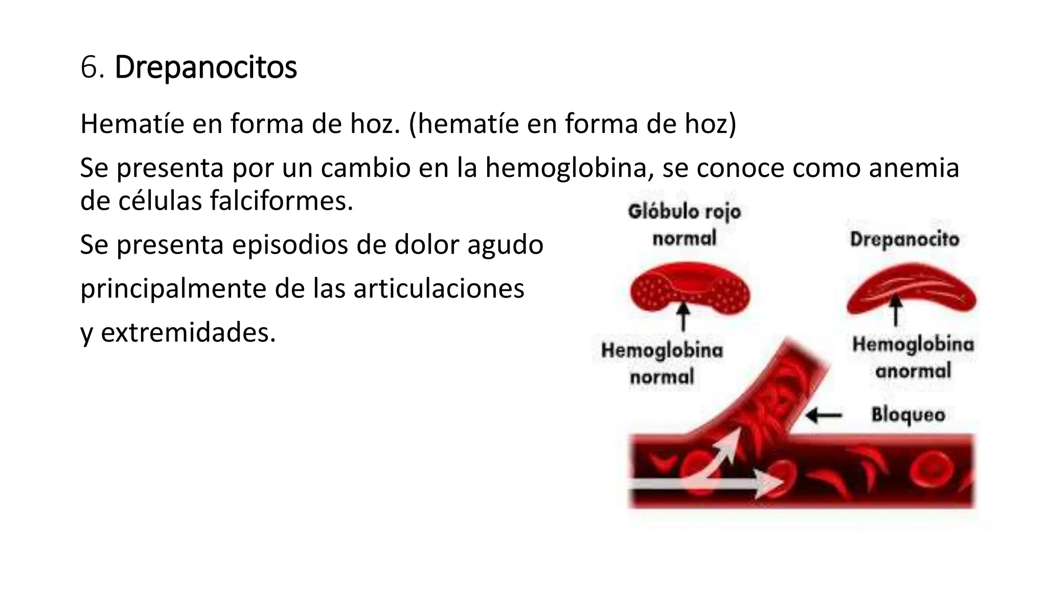 6. Drepanocitos
Hematíe en forma de hoz. (hematíe en forma de hoz)
Se presenta por un cambio en la hemoglobina, se conoce como anemia
de células falciformes.
Se presenta episodios de dolor agudo
principalmente de las articulaciones
y extremidades.
 