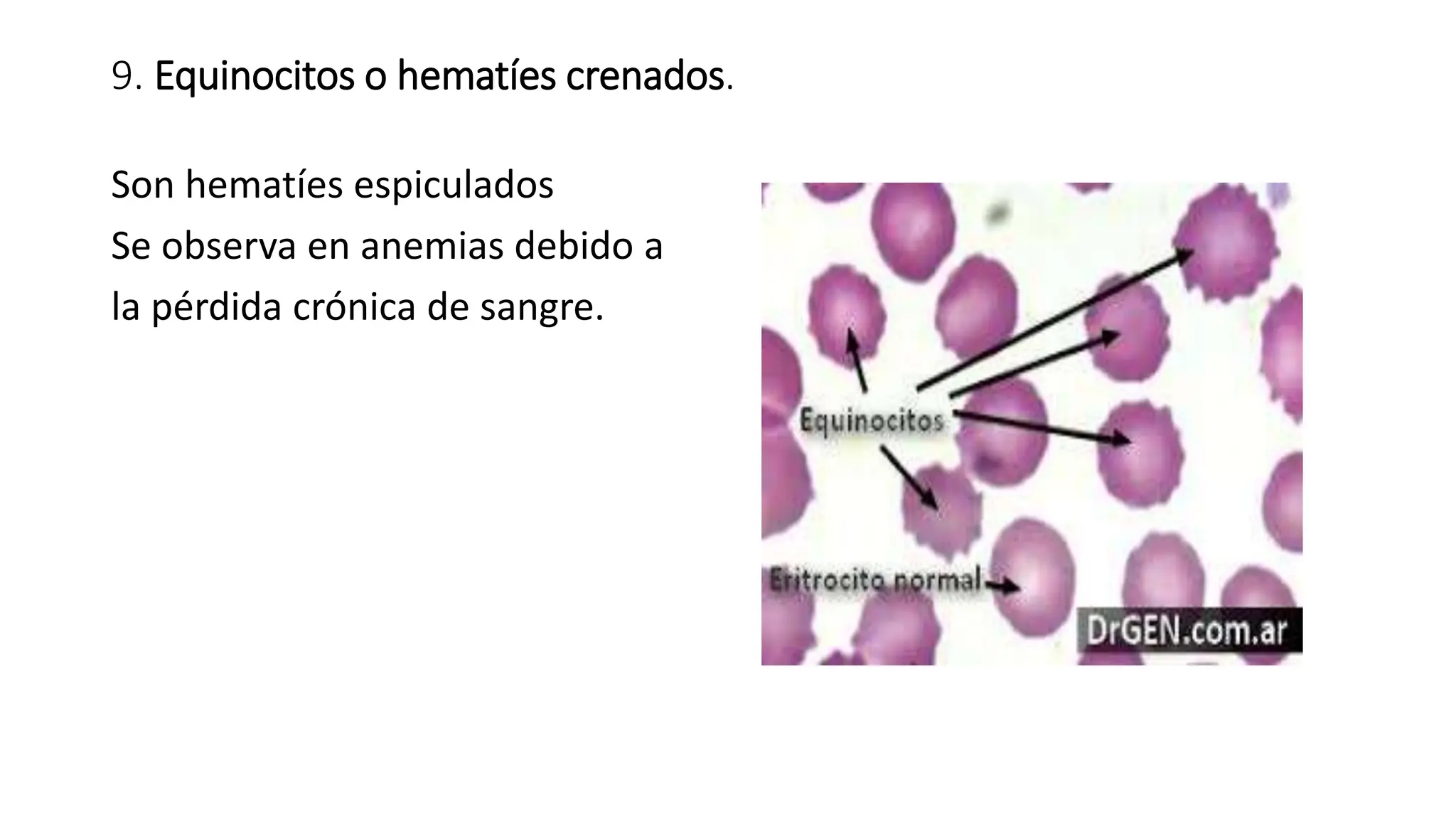 9. Equinocitos o hematíes crenados.
Son hematíes espiculados
Se observa en anemias debido a
la pérdida crónica de sangre.
 