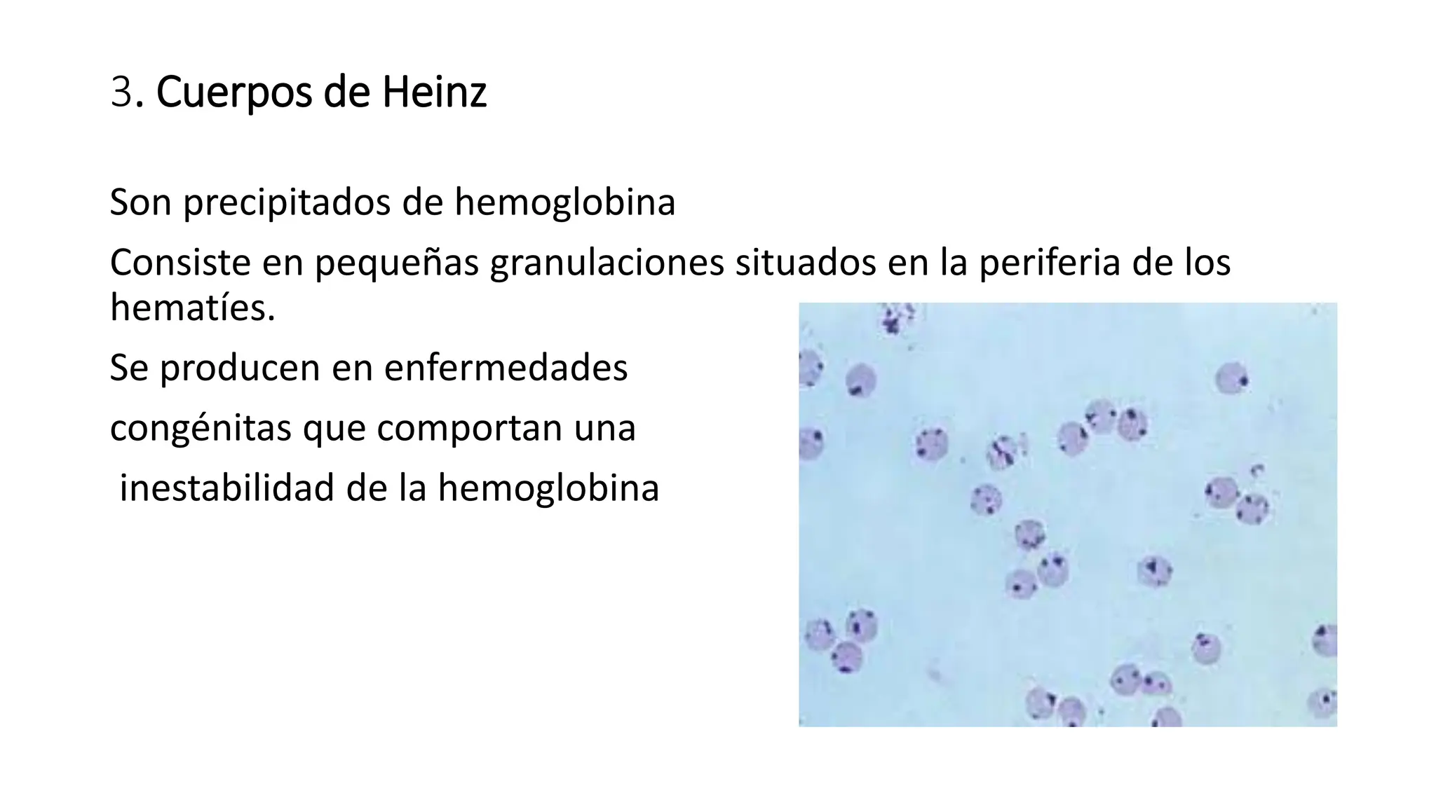 3. Cuerpos de Heinz
Son precipitados de hemoglobina
Consiste en pequeñas granulaciones situados en la periferia de los
hematíes.
Se producen en enfermedades
congénitas que comportan una
inestabilidad de la hemoglobina
 