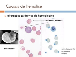 Causas de hemólise
   alterações oxidativas da hemoglobina
                               Corpúsculo de Heinz




Ecentrócito                                      coloração supra vital
                                                 novo azul de
                                                 metileno
 