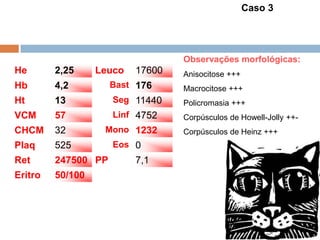 Caso 3




                                  Observações morfológicas:
He       2,25     Leuco   17600   Anisocitose +++
Hb       4,2         Bast 176     Macrocitose +++
Ht       13          Seg 11440    Policromasia +++
VCM      57          Linf 4752    Corpúsculos de Howell-Jolly ++-
CHCM     32        Mono 1232      Corpúsculos de Heinz +++
Plaq     525         Eos 0
Ret      247500 PP        7,1
Eritro   50/100
 